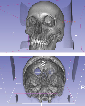 Мужчина спас зрение жены благодаря 3D печати Мужчина спас зрение жены благодаря 3D печати