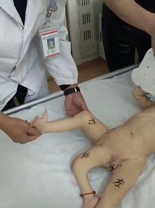 Хирурги ампутировали у младенца третью ногу