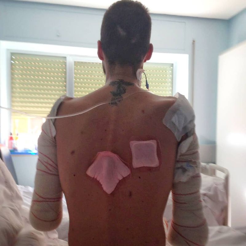 24-летний спортсмен лишился рук и ног из-за врачебной ошибки