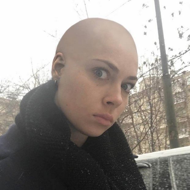 Самбурская теперь лысая