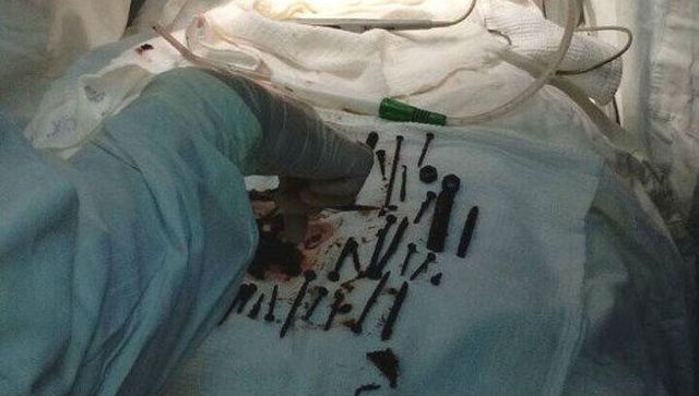 В желудке пенсионерки обнаружили гвозди, шурупы и гайки