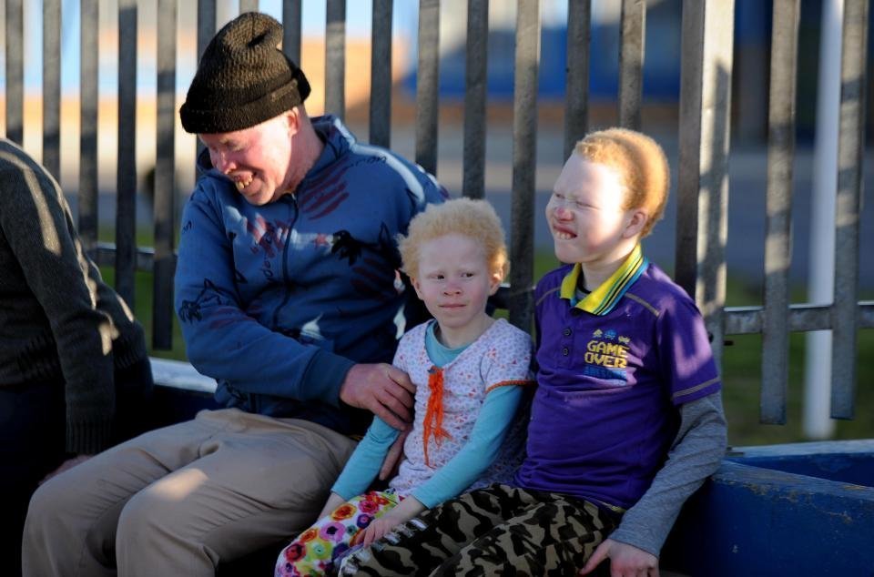 Как живется альбиносам в ЮАР Как живется альбиносам в ЮАР